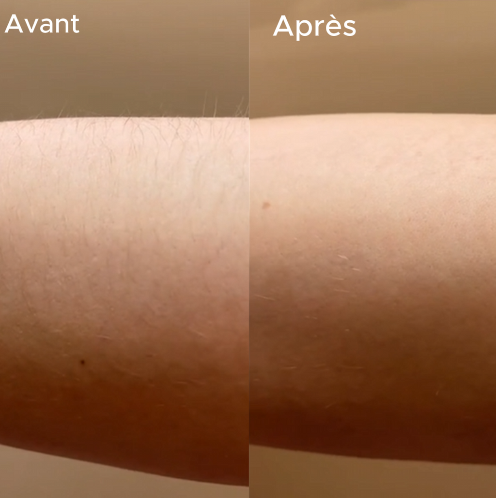 Épilateur Cristal Nano-Glass Thermis™
