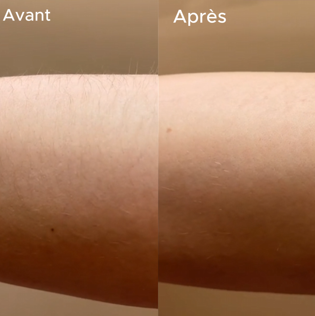 Épilateur Cristal Nano-Glass Thermis™